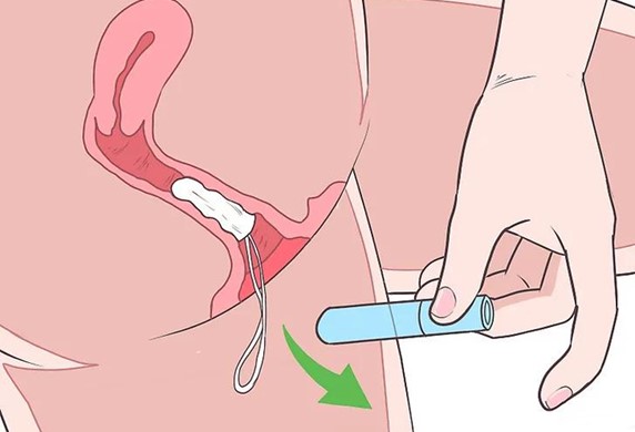 Cách sử dụng băng vệ sinh tampon chị em cần biết